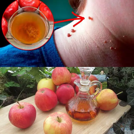 How to Remove Skin Tags Naturally at Home with Apple Cider Vinegar