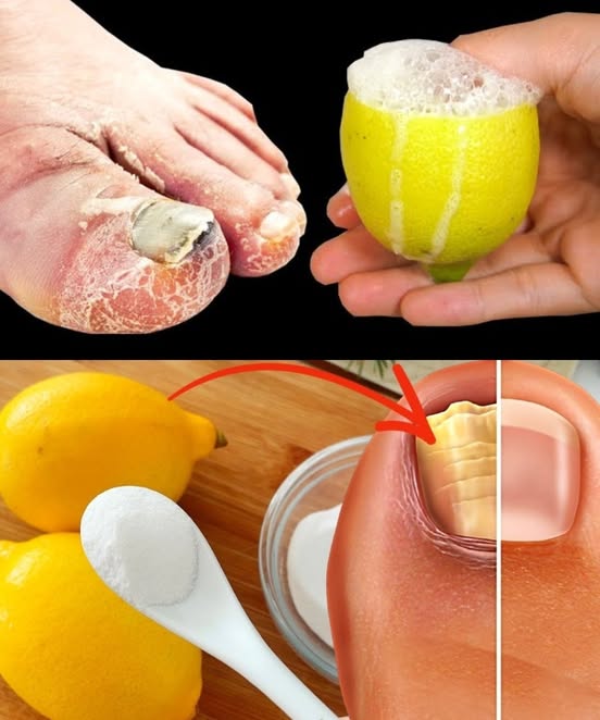 100% Natural Remedy for Toenail Fungus Removal with Lemon & Salt