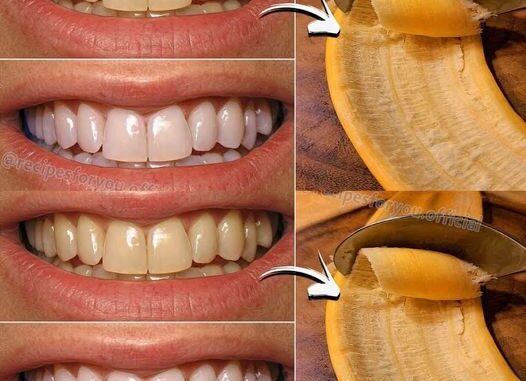 Teeth Whitening in Just 2 Minutes: Turn Yellowing and Tartar Buildup into Shiny Milky White