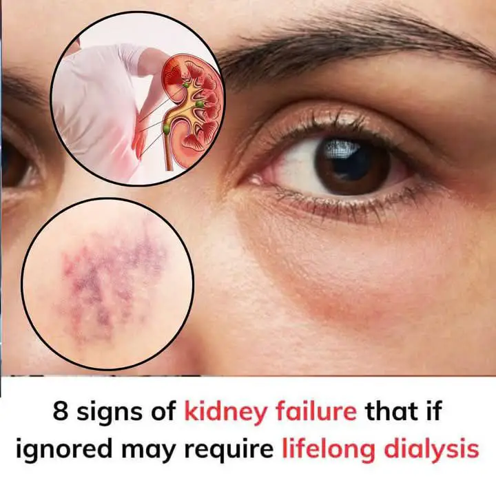 8 Warning Signs of Kidney Failure