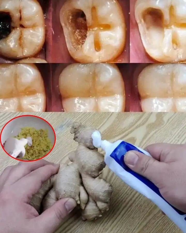 How to Naturally Repair a Cavity & Strengthen Your Teeth