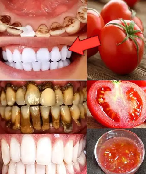 The Strongest Teeth Whitening Recipe at Home in 2 Minutes: Whitening Yellow Teeth from Tartar Naturally with Tomatoes and…