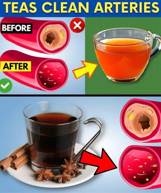 Top 3 Teas to Clear Out Your Arteries Naturally